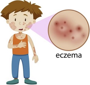 boy with eczema